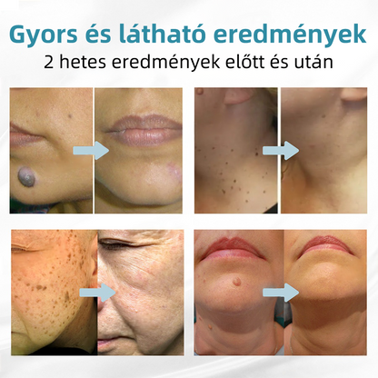 𝐤𝑖𝒅𝘴𝘯𝘦𝘦𝘥® 𝑁𝑒𝑚-𝑖𝑛𝑣𝑎𝑧í𝑣 𝐿é𝑧𝑒𝑟 𝑇𝑜𝑙𝑙 – 𝐸𝑟ő𝑠𝑒𝑛 𝑎𝑗á𝑛𝑙𝑜𝑡𝑡 𝑎 𝑀𝑎𝑔𝑦𝑎𝑟 𝐷𝑒𝑟𝑚𝑎𝑡𝑜𝑙ó𝑔𝑖𝑎𝑖 𝑇á𝑟𝑠𝑢𝑙𝑎𝑡 (𝑀𝐷𝑇) á𝑙𝑡𝑎𝑙 💖