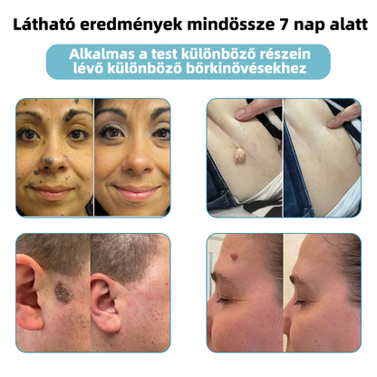 𝐤𝑖𝒅𝘴𝘯𝘦𝘦𝘥® 𝑁𝑒𝑚-𝑖𝑛𝑣𝑎𝑧í𝑣 𝐿é𝑧𝑒𝑟 𝑇𝑜𝑙𝑙 – 𝐸𝑟ő𝑠𝑒𝑛 𝑎𝑗á𝑛𝑙𝑜𝑡𝑡 𝑎 𝑀𝑎𝑔𝑦𝑎𝑟 𝐷𝑒𝑟𝑚𝑎𝑡𝑜𝑙ó𝑔𝑖𝑎𝑖 𝑇á𝑟𝑠𝑢𝑙𝑎𝑡 (𝑀𝐷𝑇) á𝑙𝑡𝑎𝑙 💖