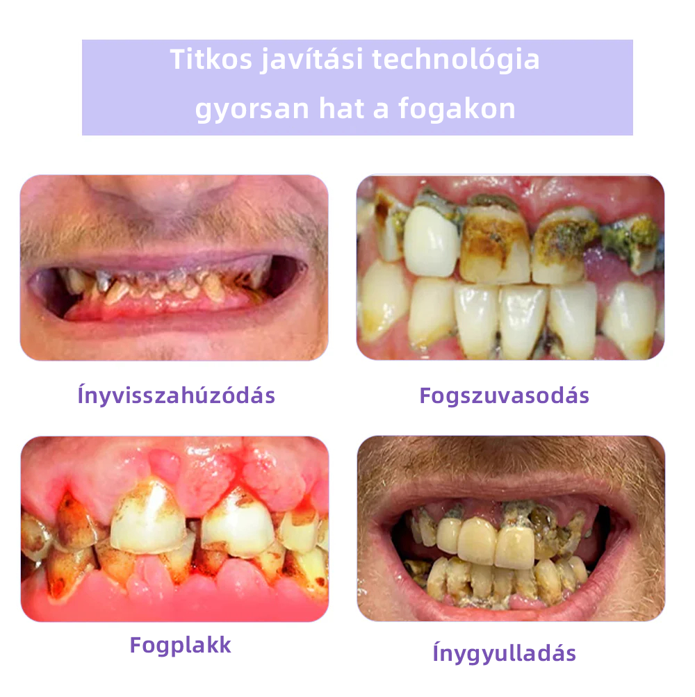 𝐎𝐲𝐢𝐤𝐞𝐲™ FOGAK HELYREÁLLÍTÁS ÁSVÁNYI POR Hatékonyan javítja a szuvasodást, ínyproblémákat, fogérzékenységet, szájfekélyeket és a fogak elszíneződését, miközben jelentősen javítja a szájüreg általános egészségét.(𝑀𝑂𝐾 𝑎𝑗á𝑛𝑙𝑜𝑡𝑡)🧑‍⚕️