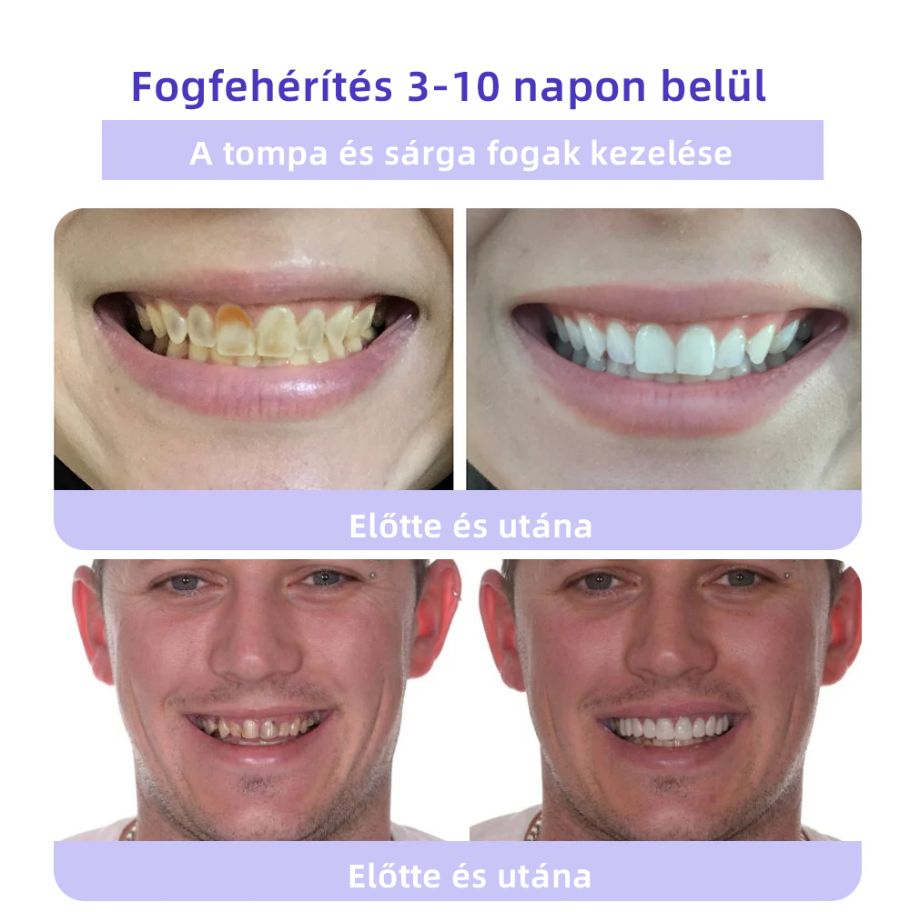 𝐎𝐲𝐢𝐤𝐞𝐲™ FOGAK HELYREÁLLÍTÁS ÁSVÁNYI POR Hatékonyan javítja a szuvasodást, ínyproblémákat, fogérzékenységet, szájfekélyeket és a fogak elszíneződését, miközben jelentősen javítja a szájüreg általános egészségét.(𝑀𝑂𝐾 𝑎𝑗á𝑛𝑙𝑜𝑡𝑡)🧑‍⚕️
