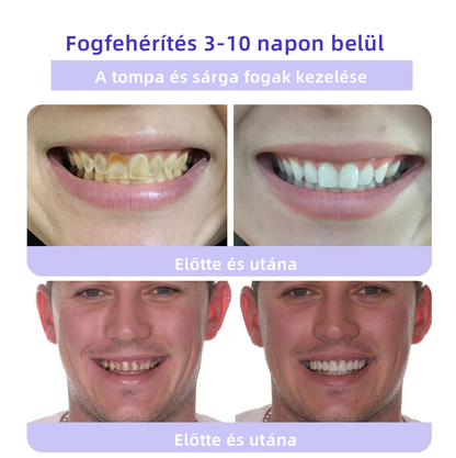 𝐎𝐲𝐢𝐤𝐞𝐲™ FOGAK HELYREÁLLÍTÁS ÁSVÁNYI POR Hatékonyan javítja a szuvasodást, ínyproblémákat, fogérzékenységet, szájfekélyeket és a fogak elszíneződését, miközben jelentősen javítja a szájüreg általános egészségét.(𝑀𝑂𝐾 𝑎𝑗á𝑛𝑙𝑜𝑡𝑡)🧑‍⚕️