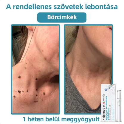 𝐤𝑖𝒅𝘴𝘯𝘦𝘦𝘥® 𝑁𝑒𝑚-𝑖𝑛𝑣𝑎𝑧í𝑣 𝐿é𝑧𝑒𝑟 𝑇𝑜𝑙𝑙 – 𝐸𝑟ő𝑠𝑒𝑛 𝑎𝑗á𝑛𝑙𝑜𝑡𝑡 𝑎 𝑀𝑎𝑔𝑦𝑎𝑟 𝐷𝑒𝑟𝑚𝑎𝑡𝑜𝑙ó𝑔𝑖𝑎𝑖 𝑇á𝑟𝑠𝑢𝑙𝑎𝑡 (𝑀𝐷𝑇) á𝑙𝑡𝑎𝑙 💖