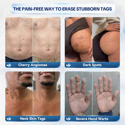 ✨🛒𝐏𝐢𝐜𝐝𝐨® 7-𝐃𝐚𝐲 𝐒𝐤𝐢𝐧 𝐓𝐚𝐠 & 𝐒𝐩𝐨𝐭 𝐄𝐫𝐚𝐬𝐞𝐫 𝐂𝐫𝐞𝐚𝐦🩵 (Zero Pain, Zero 𝐒𝐜𝐚𝐫𝐬 Formula)