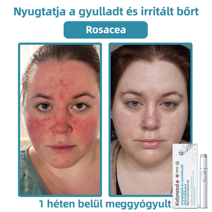 𝐤𝑖𝒅𝘴𝘯𝘦𝘦𝘥® 𝑁𝑒𝑚-𝑖𝑛𝑣𝑎𝑧í𝑣 𝐿é𝑧𝑒𝑟 𝑇𝑜𝑙𝑙 – 𝐸𝑟ő𝑠𝑒𝑛 𝑎𝑗á𝑛𝑙𝑜𝑡𝑡 𝑎 𝑀𝑎𝑔𝑦𝑎𝑟 𝐷𝑒𝑟𝑚𝑎𝑡𝑜𝑙ó𝑔𝑖𝑎𝑖 𝑇á𝑟𝑠𝑢𝑙𝑎𝑡 (𝑀𝐷𝑇) á𝑙𝑡𝑎𝑙 💖