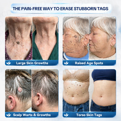 ✨🛒𝐏𝐢𝐜𝐝𝐨® 7-𝐃𝐚𝐲 𝐒𝐤𝐢𝐧 𝐓𝐚𝐠 & 𝐒𝐩𝐨𝐭 𝐄𝐫𝐚𝐬𝐞𝐫 𝐂𝐫𝐞𝐚𝐦🩵 (Zero Pain, Zero 𝐒𝐜𝐚𝐫𝐬 Formula)