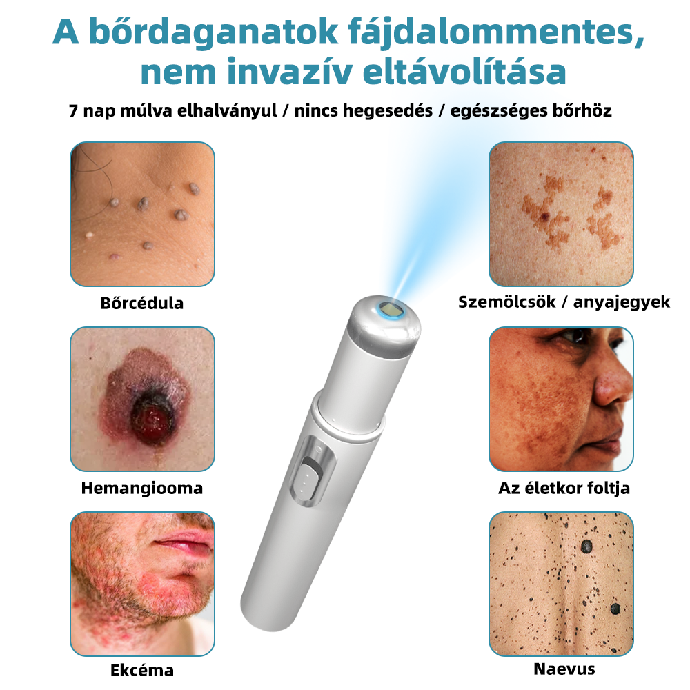 𝐤𝑖𝒅𝘴𝘯𝘦𝘦𝘥® 𝑁𝑒𝑚-𝑖𝑛𝑣𝑎𝑧í𝑣 𝐿é𝑧𝑒𝑟 𝑇𝑜𝑙𝑙 – 𝐸𝑟ő𝑠𝑒𝑛 𝑎𝑗á𝑛𝑙𝑜𝑡𝑡 𝑎 𝑀𝑎𝑔𝑦𝑎𝑟 𝐷𝑒𝑟𝑚𝑎𝑡𝑜𝑙ó𝑔𝑖𝑎𝑖 𝑇á𝑟𝑠𝑢𝑙𝑎𝑡 (𝑀𝐷𝑇) á𝑙𝑡𝑎𝑙 💖