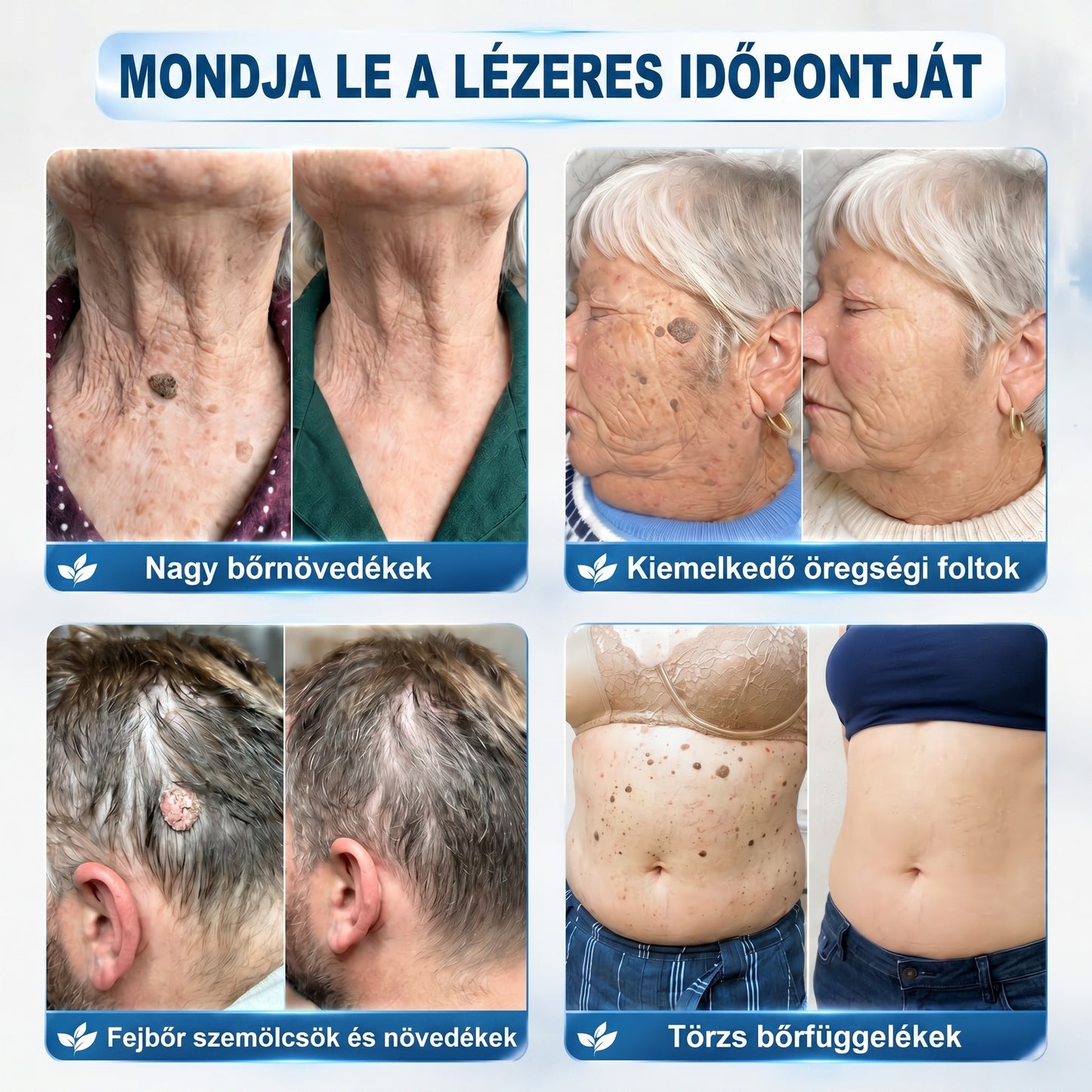 Hivatalos márkabolt | ✅👩‍⚕️ 𝐏i𝐜𝐝o® 7-Napos 𝗧𝗮𝗴 & 𝗦𝗽𝗼𝘁 𝐄𝐫𝐚𝘀𝐞𝐫 (Fájdalommentes, heg nélküli – golyós applikátor) 🎉