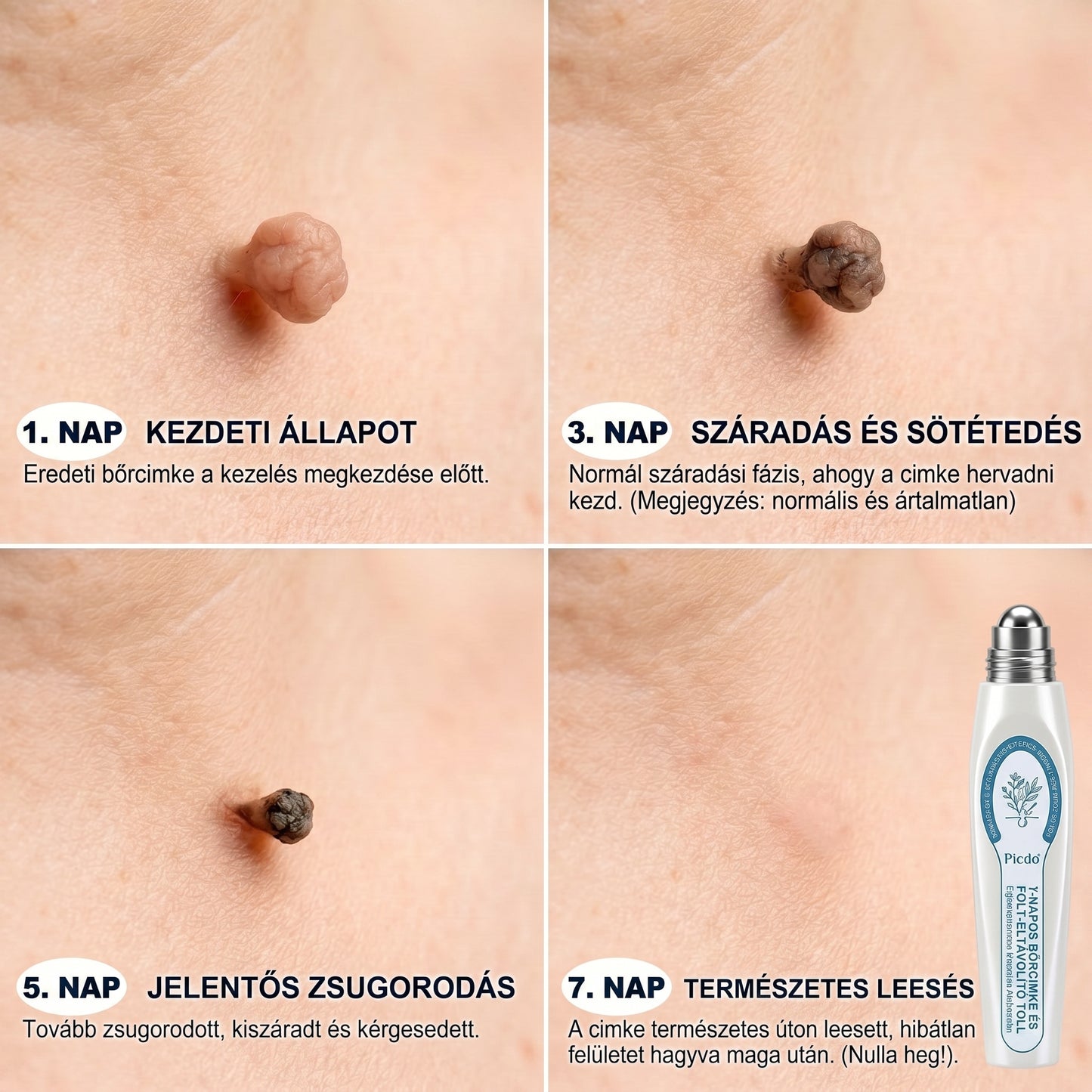 Hivatalos márkabolt | ✅👩‍⚕️ 𝐏i𝐜𝐝o® 7-Napos 𝗧𝗮𝗴 & 𝗦𝗽𝗼𝘁 𝐄𝐫𝐚𝘀𝐞𝐫 (Fájdalommentes, heg nélküli – golyós applikátor) 🎉