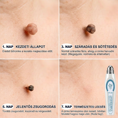 Hivatalos márkabolt | ✅👩‍⚕️ 𝐏i𝐜𝐝o® 7-Napos 𝗧𝗮𝗴 & 𝗦𝗽𝗼𝘁 𝐄𝐫𝐚𝘀𝐞𝐫 (Fájdalommentes, heg nélküli – golyós applikátor) 🎉
