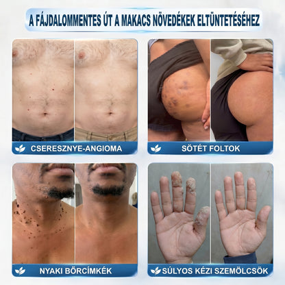 Hivatalos márkabolt | ✅👩‍⚕️ 𝐏i𝐜𝐝o® 7-Napos 𝗧𝗮𝗴 & 𝗦𝗽𝗼𝘁 𝐄𝐫𝐚𝘀𝐞𝐫 (Fájdalommentes, heg nélküli – golyós applikátor) 🎉