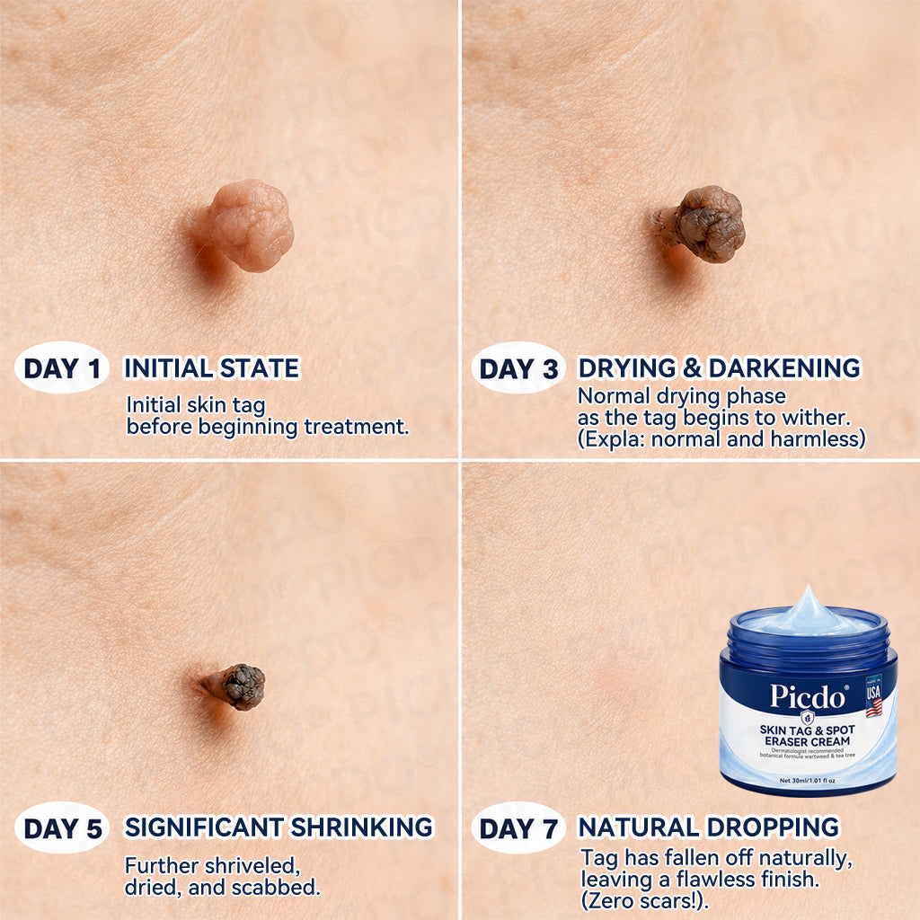 ✨🛒𝐏𝐢𝐜𝐝𝐨® 7-𝐃𝐚𝐲 𝐒𝐤𝐢𝐧 𝐓𝐚𝐠 & 𝐒𝐩𝐨𝐭 𝐄𝐫𝐚𝐬𝐞𝐫 𝐂𝐫𝐞𝐚𝐦🩵 (Zero Pain, Zero 𝐒𝐜𝐚𝐫𝐬 Formula)